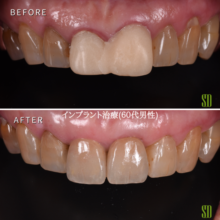 症例紹介3：インプラント治療（60代男性）