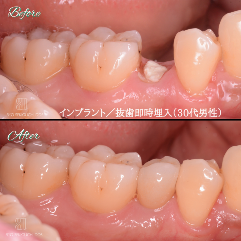 症例紹介5：インプラント治療（30代男性）