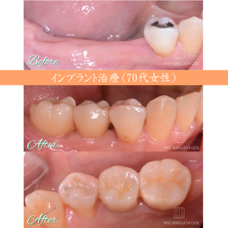 症例紹介9：インプラント治療（70代女性）